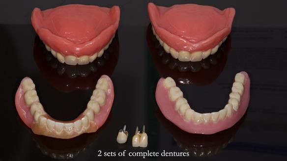 Newsletter 83: Sheila’s Complete Denture Success