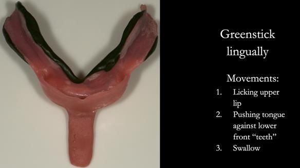 Greenstick right - right and left lingually from second molar to second molar – avoiding the retromolar pad - this is moulded in the patients mouth by the patient licking the upper lip from right to left commissures, pushing the tongue against the lower