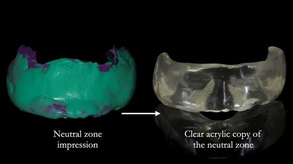 Newsletter 83: Sheila’s Complete Denture Success