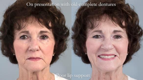 Newsletter 75: Marion’s case - Step-by-step complete denture workflow
