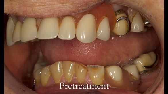 Eileen's transformation with upper and lower RPDs of Scandinavian hygienic design FULL PROTOCOL