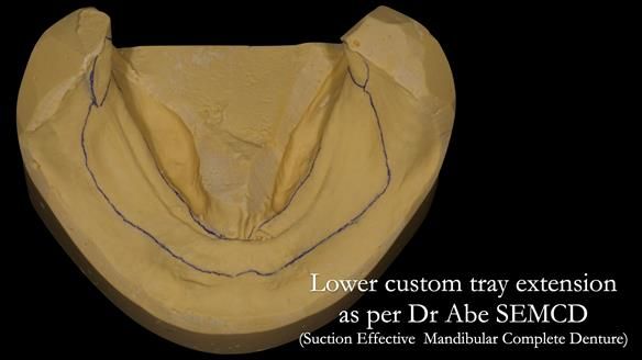 Newsletter 50 Special edition Complete Dentures FULL PROTOCOL