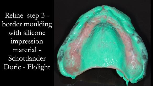 Newsletter 54 case presentation upper complete denture and lower Scandinavian designed hygienic partial denture for David