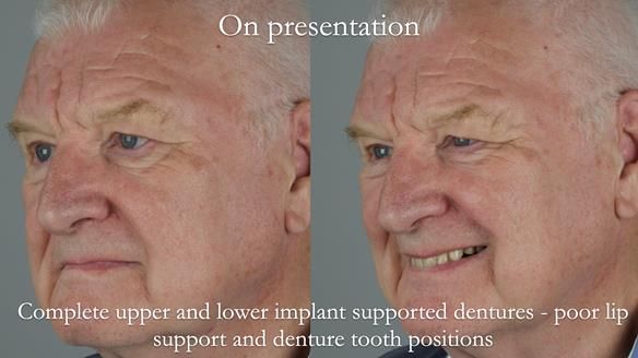 Newsletter 57 showcases the making and fitting process of implant-supported complete dentures for Alisdair