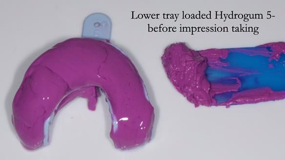 Finlay's Newsletter 64 case study - provision of a Kennedy class 2 metal based Scandinavian RPD for Ian