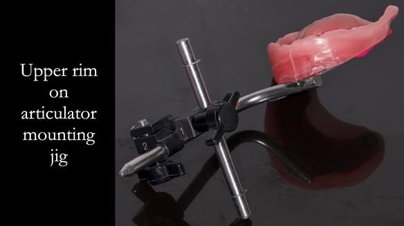 Newsletter 52 Managing Jo’s failing dentition with extractions and Mk 1/Mk 2 complete upper dentures and lower partial dentures FULL PROTOCOL