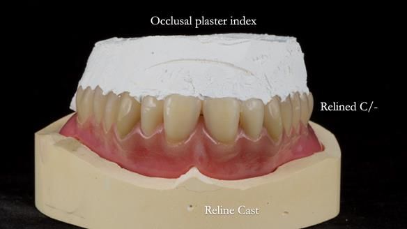 Newsletter 54 case presentation upper complete denture and lower Scandinavian designed hygienic partial denture for David