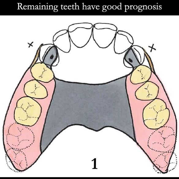 Universal Scandinavian partial denture designs