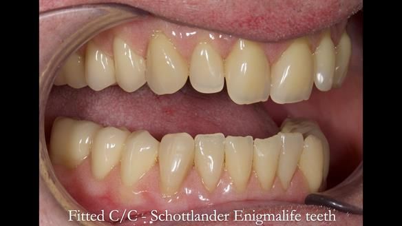 Complete denture Class II div 2 deep overbite Newsletter 39