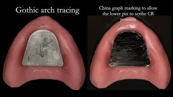 Newsletter 75: Marion’s case - Step-by-step complete denture workflow