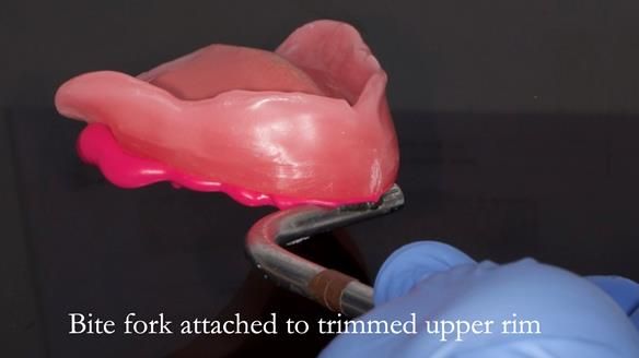 Newsletter 80 - Gordon’s dentures: the one case in 1,000 where my technique failed
