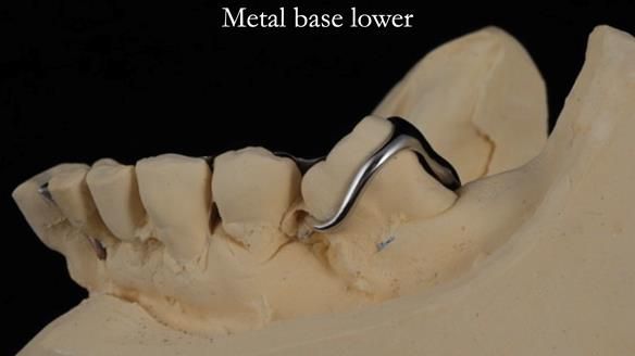 Newsletter 54 case presentation upper complete denture and lower Scandinavian designed hygienic partial denture for David