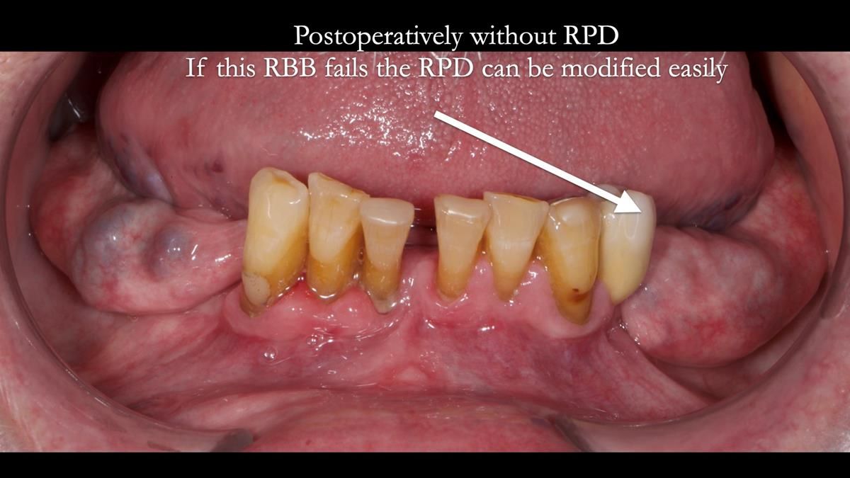 Newsletter 87 – Father Peter: A Partial Denture that needed Minor Miracle