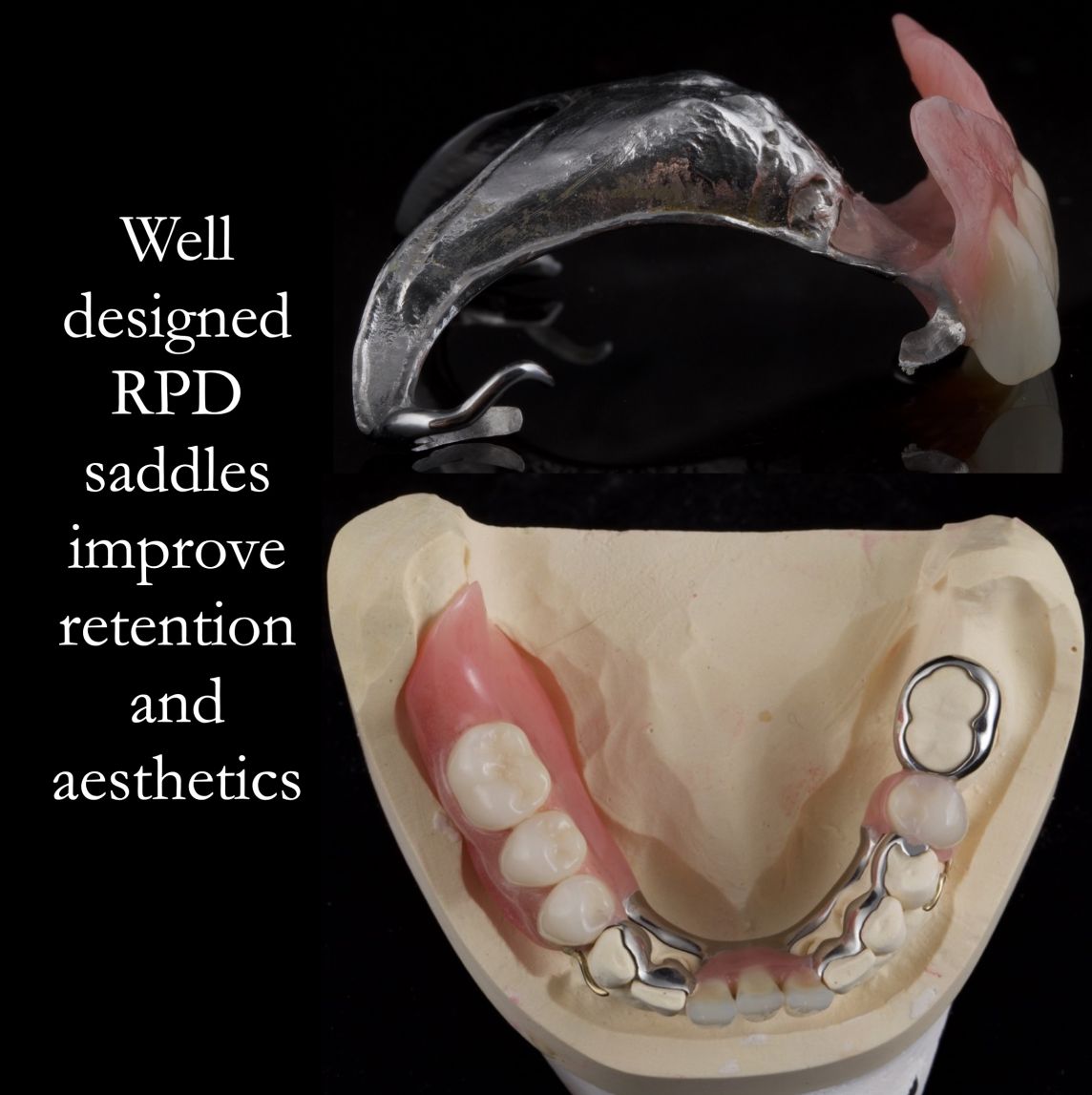 Partial dentures – shapes of saddles