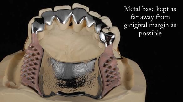 Newsletter 56 showing the making and fitting of a bilateral free end saddle upper removable partial denture (RPD) for patient with pemphigus