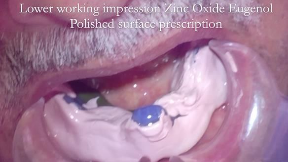 Finlay's Newsletter 62 provision of extractions and metal based complete dentures for Rafique