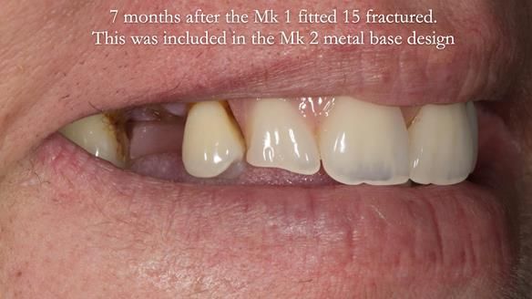 Finlay's Newsletter 63 Case study provision of metal based Scandinavian RPD - functional 10 years on