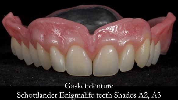 Finlay's Newsletter 58 Gasket upper partial denture for Zoe