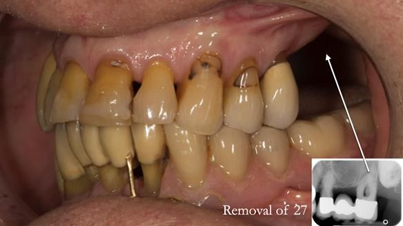 Ken – going downhill, first class