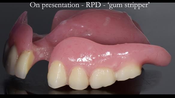Finlay's Newsletter 59 Ultra hard partial dentures made for Gill