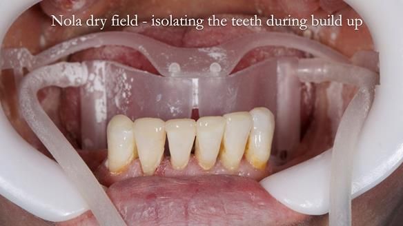Newsletter 52 Managing Jo’s failing dentition with extractions and Mk 1/Mk 2 complete upper dentures and lower partial dentures FULL PROTOCOL