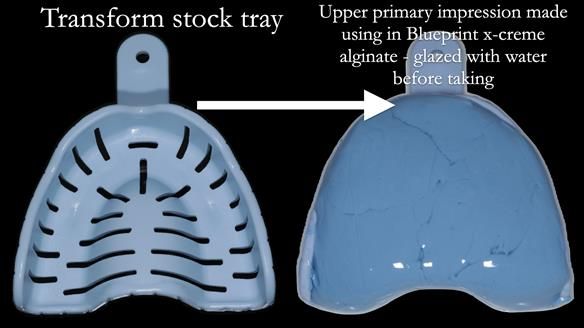 Finlay's Newsletter 61 provision of a lower unilateral free end saddle metal based partial denture for Joyce