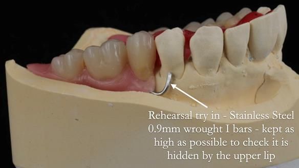Newsletter 56 showing the making and fitting of a bilateral free end saddle upper removable partial denture (RPD) for patient with pemphigus