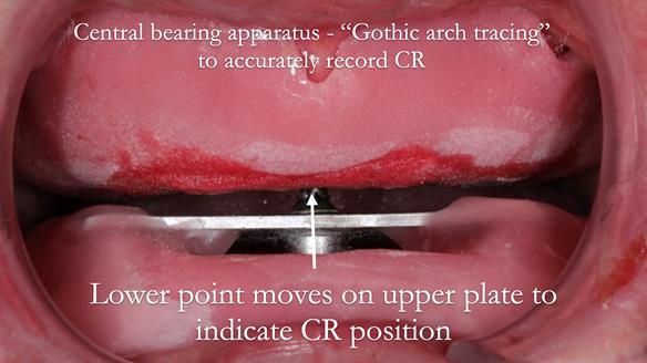 Newsletter 48 Mavis's Complete denture FULL PROTOCOL