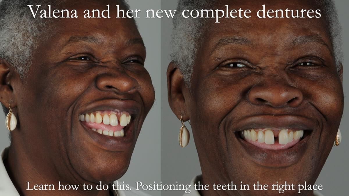 Newsletter 56 showing the making and fitting of a bilateral free end saddle upper removable partial denture (RPD) for patient with pemphigus