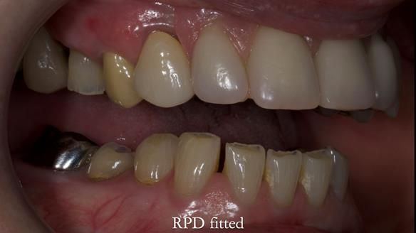 Newsletter 81 - Pam’s Story — how a partial denture changed her life (+ live walkthrough this Thursday)