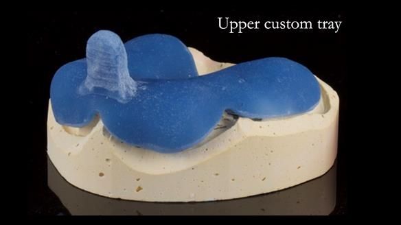 Newsletter 77: Jeremy’s case – immediate complete upper denture