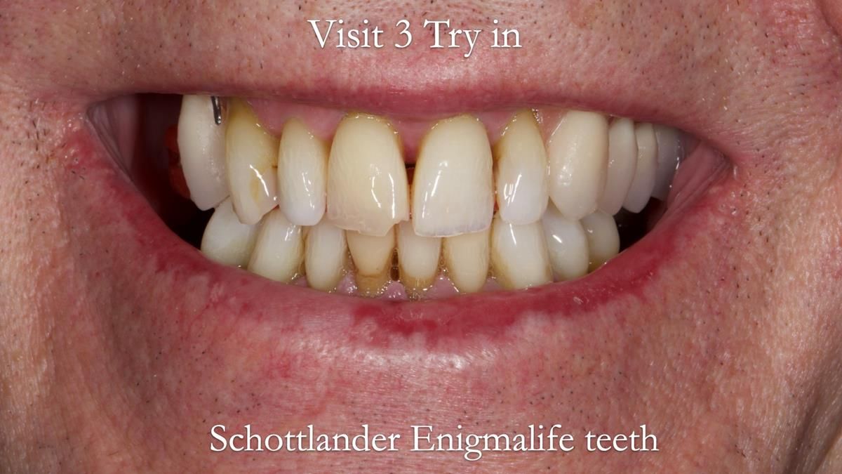 Newsletter 89 – Simon: A Challenging Kennedy Class II Division 1 Upper CoCr Partial Denture with a High Smile Line