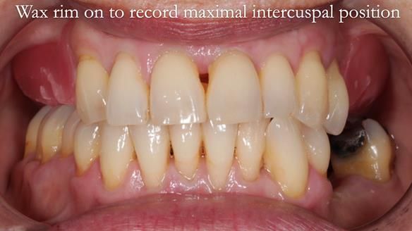 Newsletter 56 showing the making and fitting of a bilateral free end saddle upper removable partial denture (RPD) for patient with pemphigus