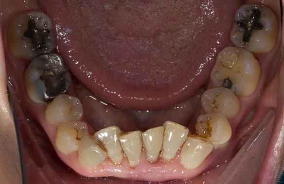 Figure 10 lower arch preoperatively