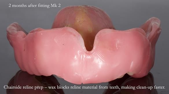 Newsletter 77: Jeremy’s case – immediate complete upper denture