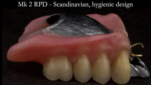 Finlay's Case Study Newsletter 40 - Immediate Mk 1 RPD to Definitive Mk 2 RPD - full protocol