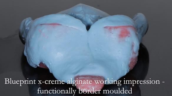 Finlay's Newsletter 59 Ultra hard partial dentures made for Gill
