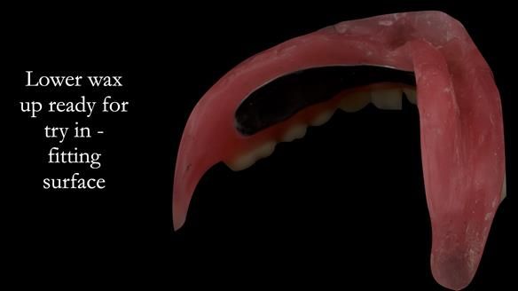 Wax try in ready for visit 4 - notice distinct shape of the denture