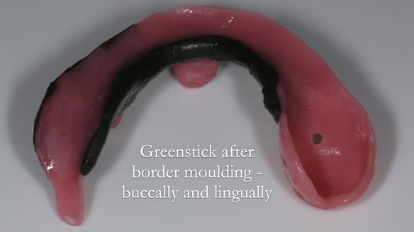 Finlay's Newsletter 59 Ultra hard partial dentures made for Gill