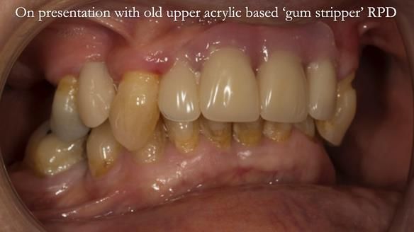 Newsletter 71 Jean’s Class I Mod III RPD: See my mistakes Fractured Mk1 to a Stronger Mk2 RPD (4 years on)