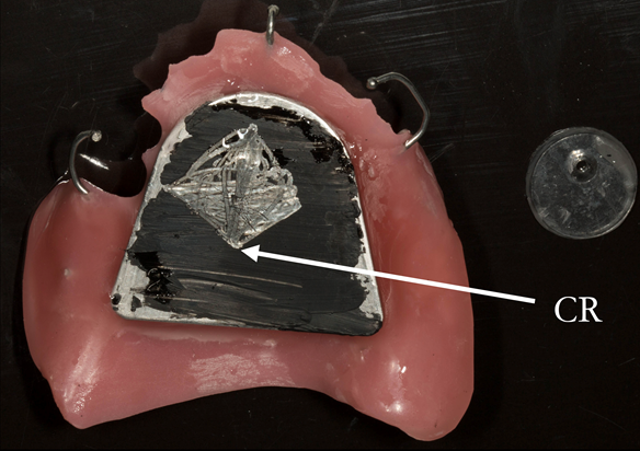 Figure 22 Inter-maxillary registration with central bearing apparatus. Maxillary plate with china graph pencil marking with arrow head scribed showing precise CR