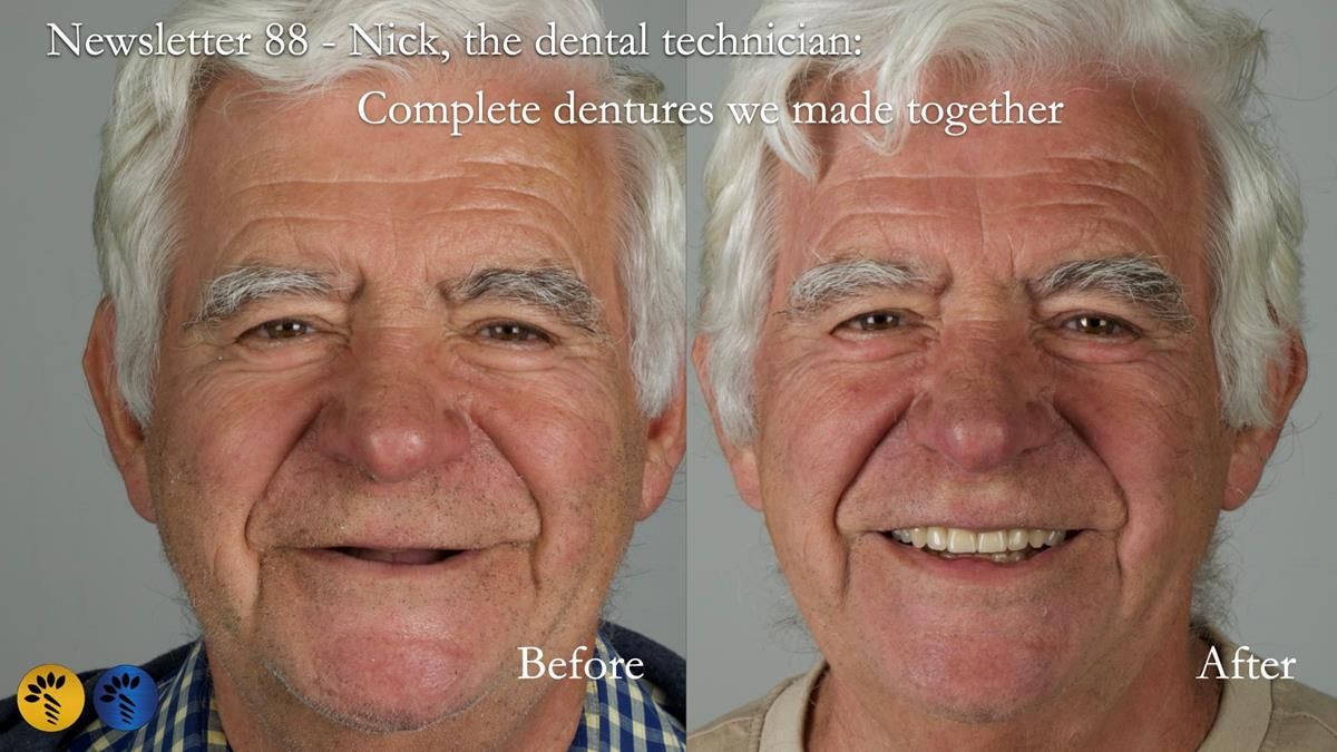 Fin’s Newsletter 88 — Complete dentures - full protocol… he rearranged his own teeth!