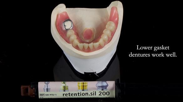 Finlay's Newsletter 58 Gasket upper partial denture for Zoe