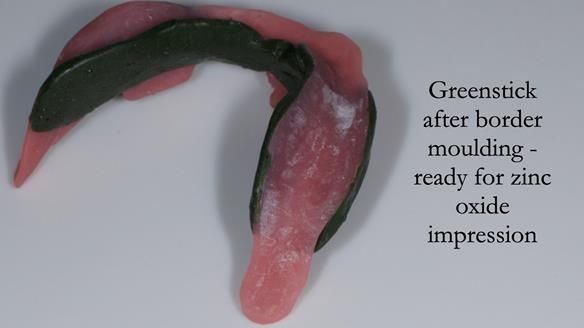 Complete denture Class II div 2 deep overbite Newsletter 39