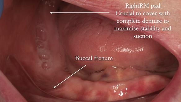 Newsletter 75: Marion’s case - Step-by-step complete denture workflow
