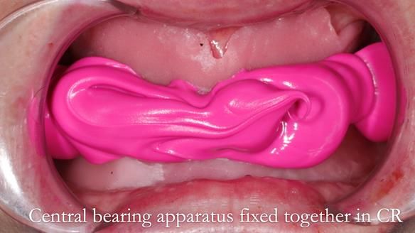 Newsletter 48 Mavis's Complete denture FULL PROTOCOL