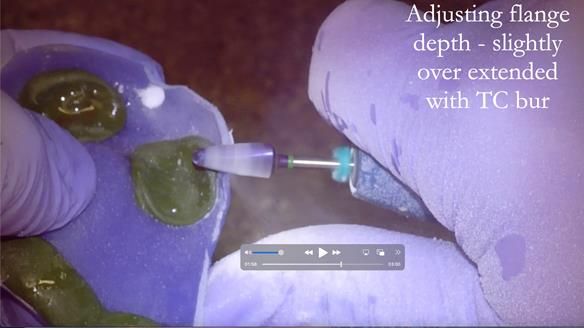 Finlay's Newsletter 62 provision of extractions and metal based complete dentures for Rafique