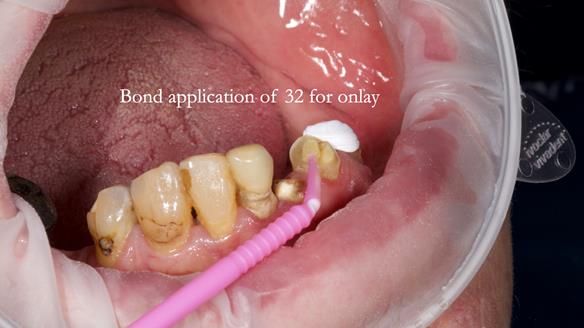 Newsletter 55 Provision of metal based partial dentures for Zephyrine with a repaired cleft lip and palate