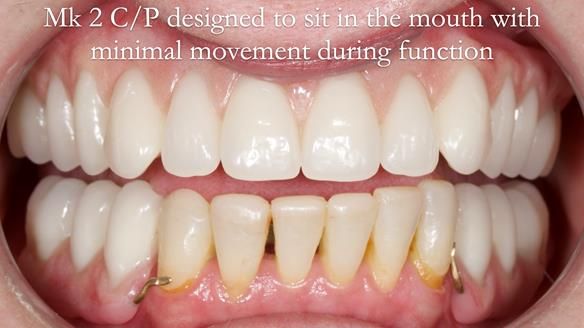 Newsletter 52 Managing Jo’s failing dentition with extractions and Mk 1/Mk 2 complete upper dentures and lower partial dentures FULL PROTOCOL