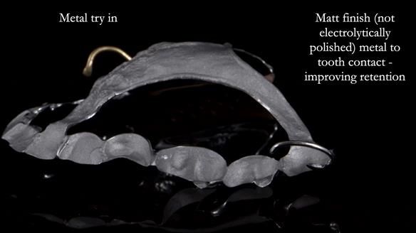 Finlay's Newsletter 64 case study - provision of a Kennedy class 2 metal based Scandinavian RPD for Ian